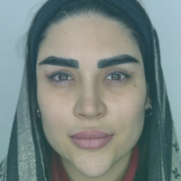 Blepharoplasty before and after results in Turkey at Dr. Sohrabi Clinic