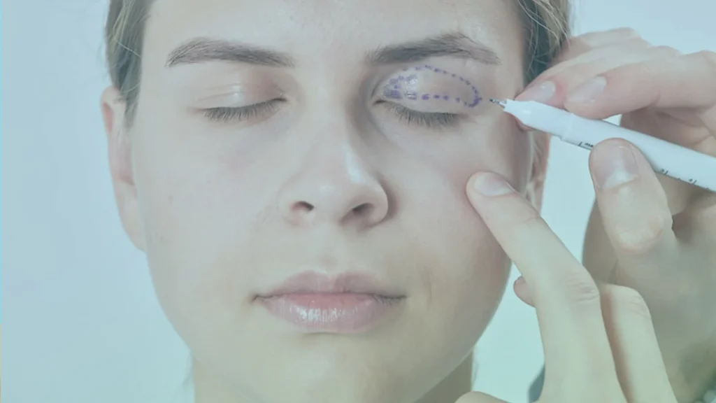 Göz Kapağı Estetiği Türkiye