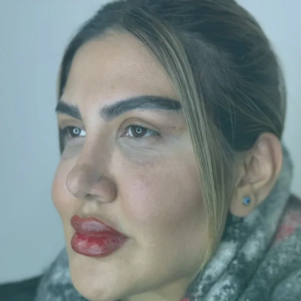 Blepharoplasty before and after results in Turkey at Dr. Sohrabi Clinic