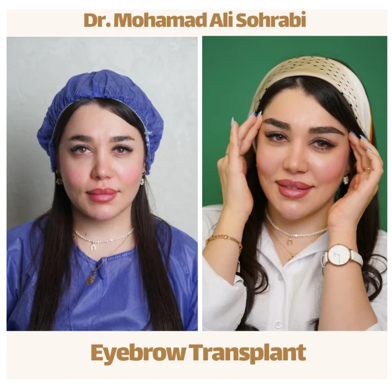 eyebrow micro-implant