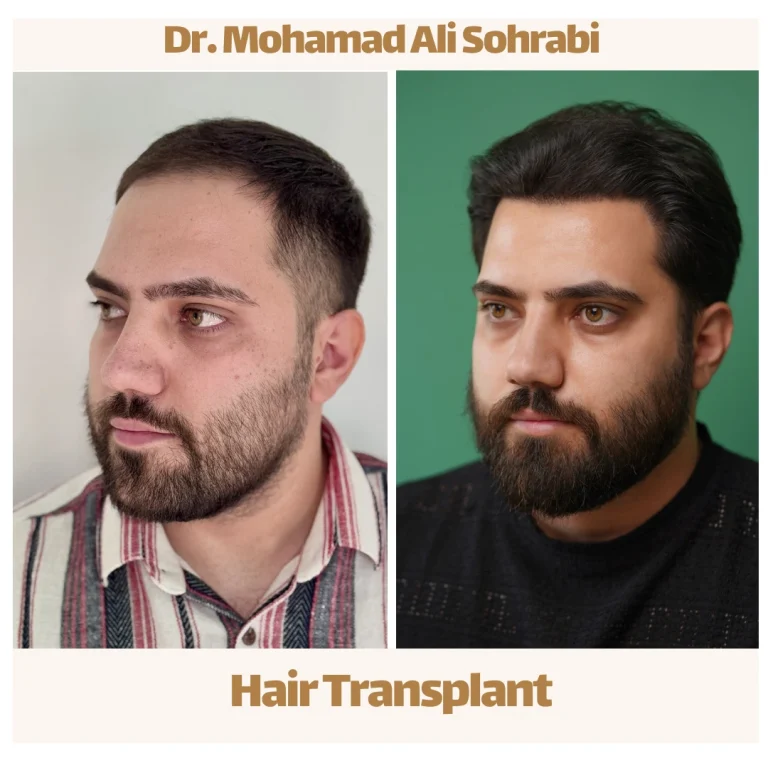 high density hair transplant